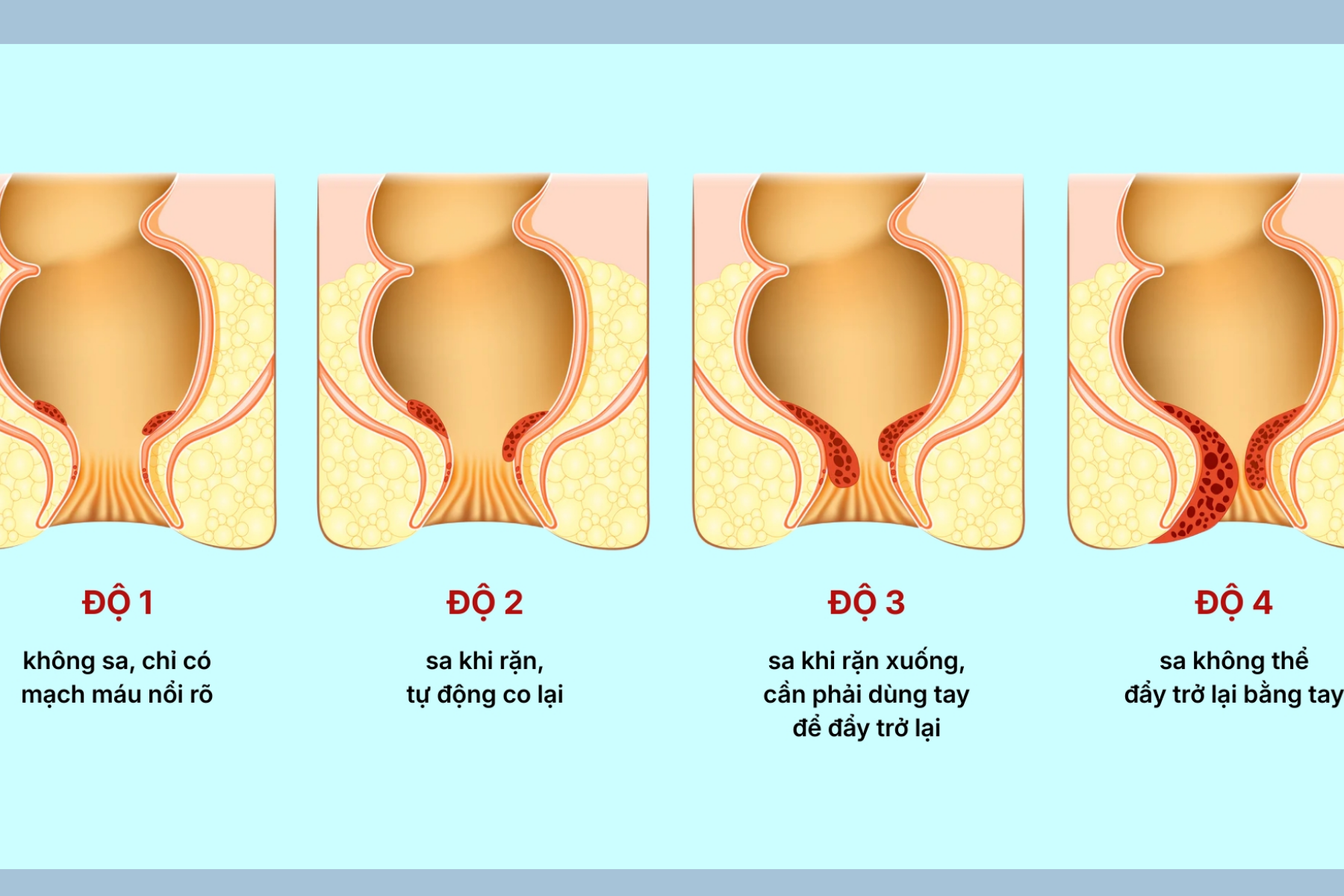 Điều trị trĩ nội - Trĩ nội thường được chia thành 4 cấp độ