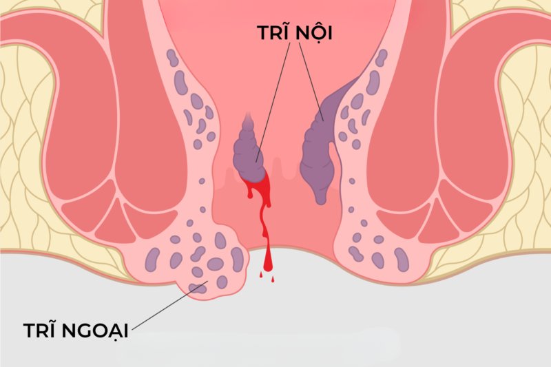 Điều trị trĩ ngoại tại nhà - Hình ảnh mô phỏng bệnh trĩ nội và trĩ ngoại