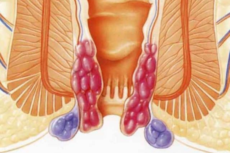 Cách điều trị trĩ hiệu quả - Các búi trĩ được hình thành