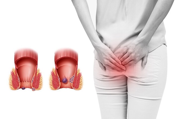 Cách điều trị trĩ nội hiệu quả từ độ 1 đến độ 4 theo khuyến cáo chuyên gia 