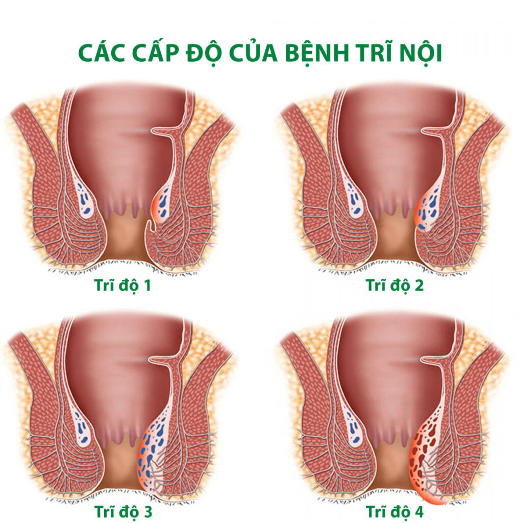 Cách điều trị trĩ nội độ 1, 2, 3 như thế nào? 7 phương pháp hỗ trợ cải thiện theo từng giai đoạn 