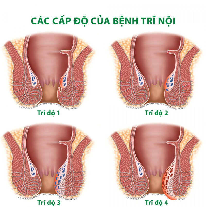 Cách điều trị trĩ nội độ 1, 2, 3 như thế nào