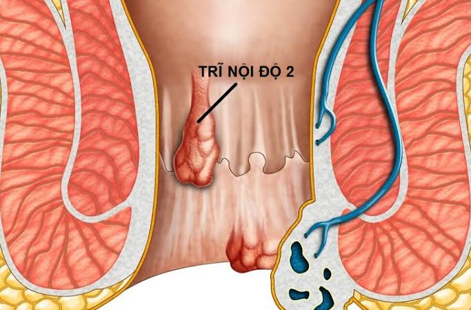 Điều trị trĩ nội độ 1, 2, 3 như thế nào? Hướng dẫn phương pháp hỗ trợ cải thiện mới nhất 2026 