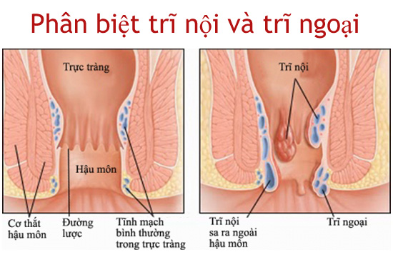 Điều trị trĩ ngoại giúp giảm đau, giảm sưng hiệu quả