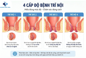 4 cấp độ bệnh trĩ nội