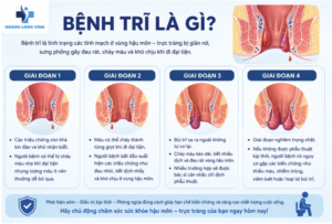 Bệnh trĩ là gì?