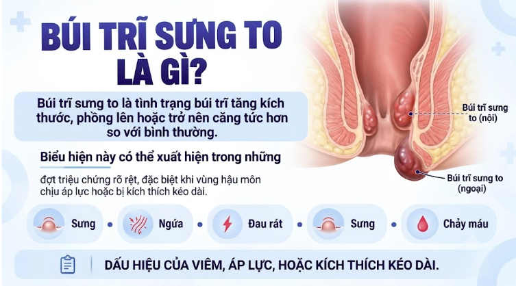 Búi trĩ sưng to là gì?