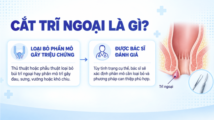 Cắt trĩ ngoại là gì?
