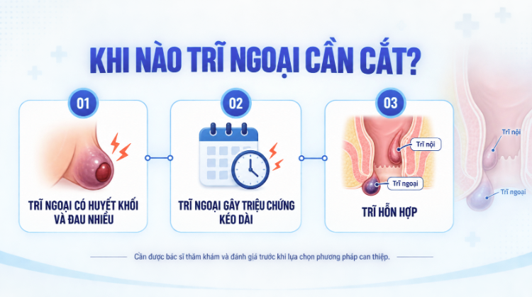 Khi nào trĩ ngoại cần cắt?