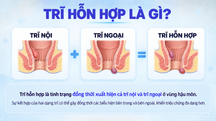 Trĩ hỗn hợp là gì?