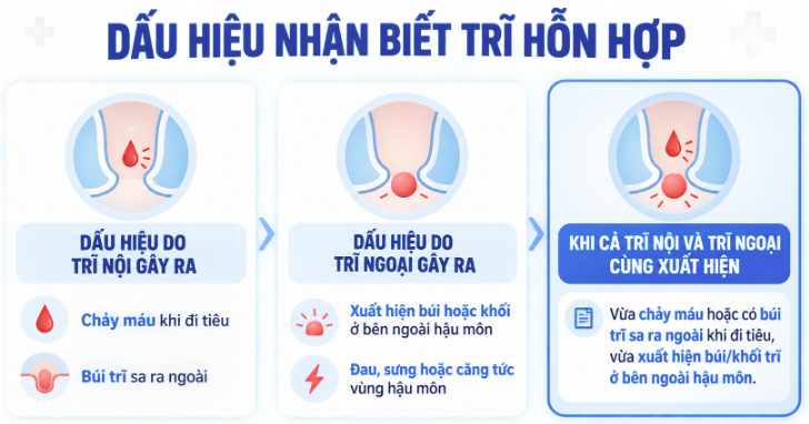 Dấu hiệu nhận biết trĩ hỗn hợp